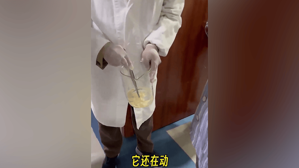 女子肛門(mén)處刺癢難忍，醫(yī)院用“南瓜籽+檳榔”驅(qū)蟲(chóng)排出長(zhǎng)達(dá)10米寄生蟲(chóng)