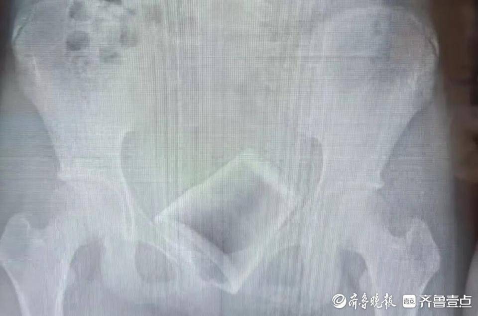 12歲男孩下體插著電線就診！醫(yī)生：這些尿道異物要注意