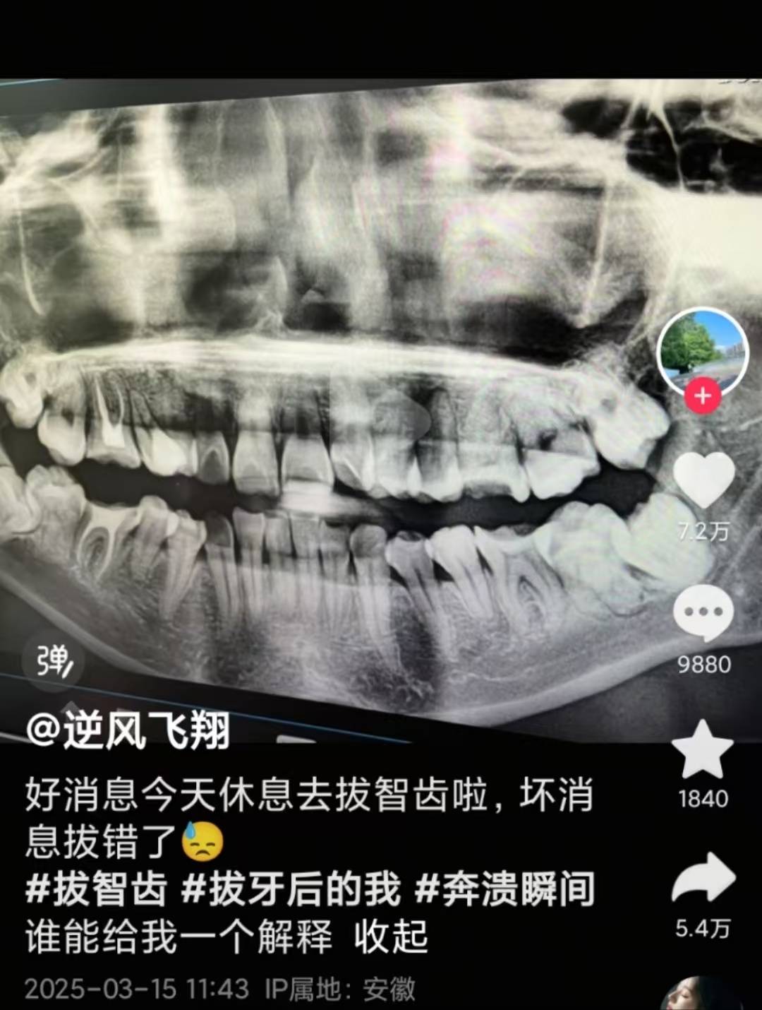 安徽一女子被拔錯牙后墜樓身亡，家屬：好牙位置沒打麻藥，硬生生拔下來