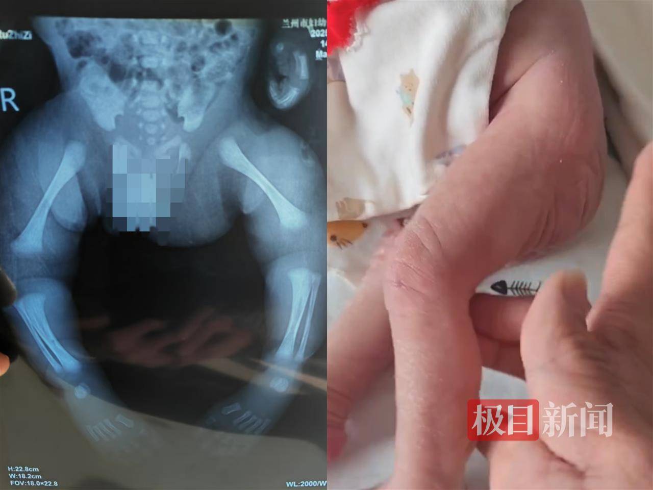 二胎出生查出先天性病癥或落下殘疾，殘疾父母稱醫(yī)院產(chǎn)檢漏檢、未盡告知義務(wù)，醫(yī)院及醫(yī)調(diào)委回應(yīng)