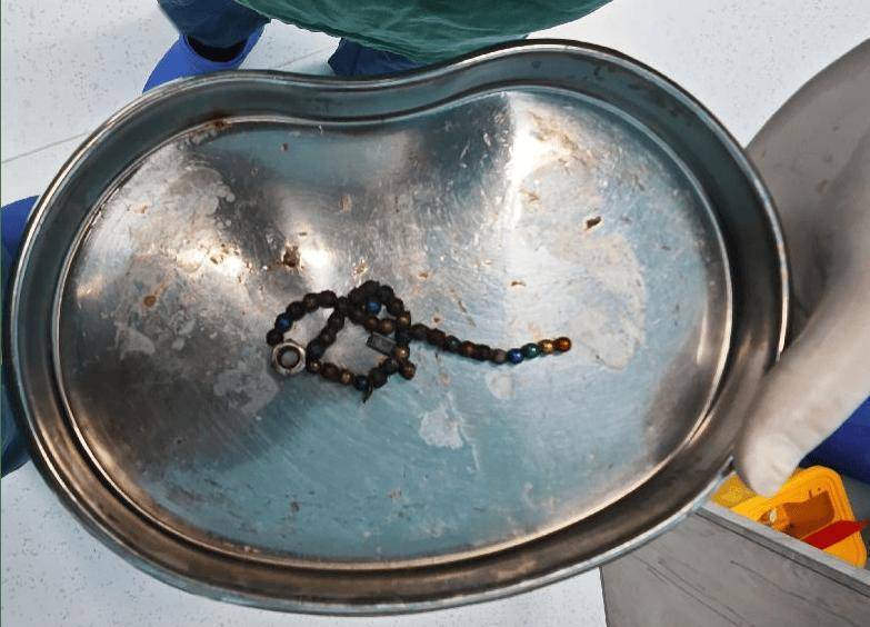 整整37顆！云南4歲孩子身體里取出……醫(yī)生緊急提醒！