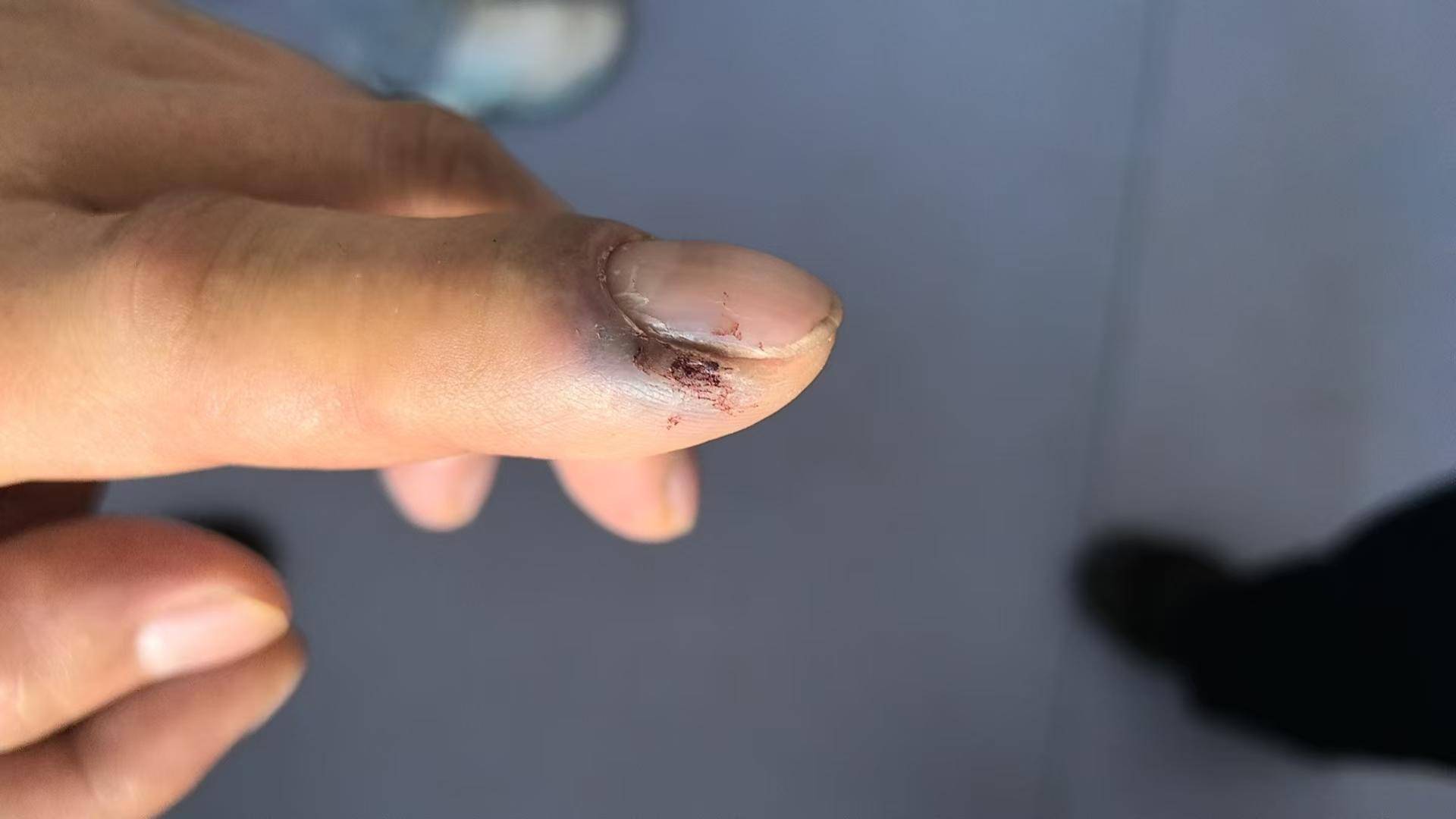 青海一男子被罕見劇毒阿拉善蝮蛇咬傷，因無血清一度想放棄治療 警車開道轉(zhuǎn)運700公里救命