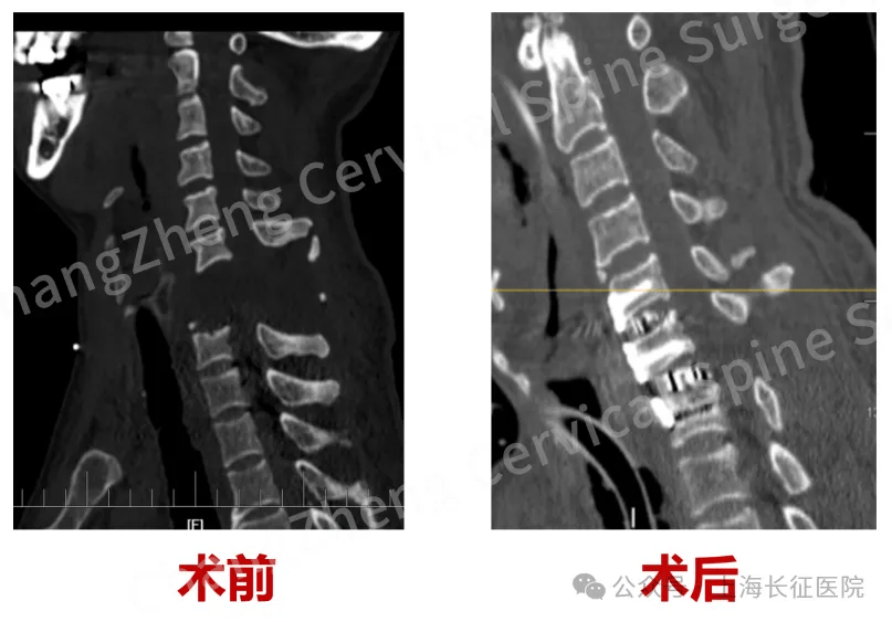 全球罕見！中國醫(yī)生救回“身首離斷”患者