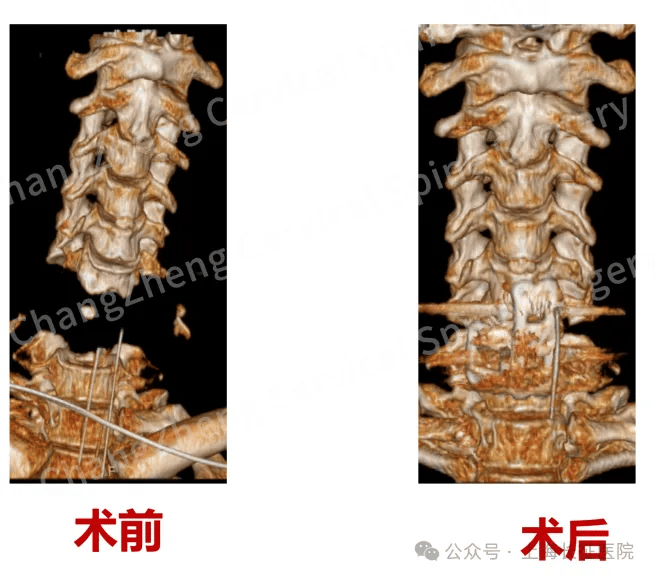 全球罕見！中國醫(yī)生救回“身首離斷”患者