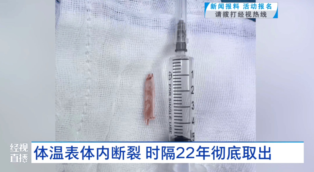 體溫表在體內(nèi)斷裂，女子時隔22年徹底取出！醫(yī)生：慶幸水銀不在里面